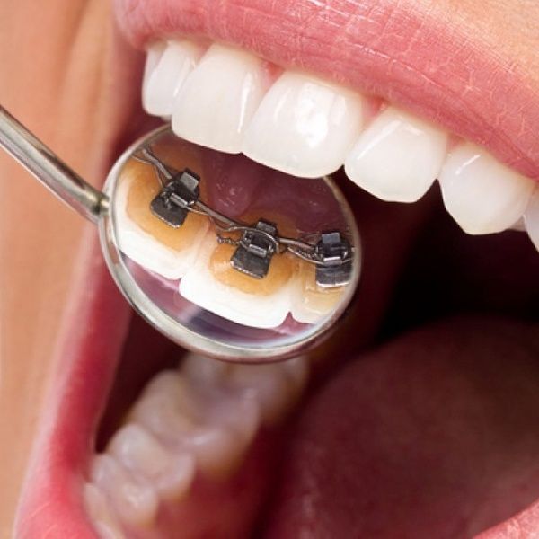 Khám phá chi tiết ưu nhược điểm các loại niềng răng phổ biến nhất.